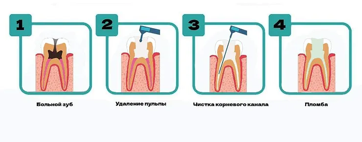 Пульпит зуба – причины возникновения и методы лечения