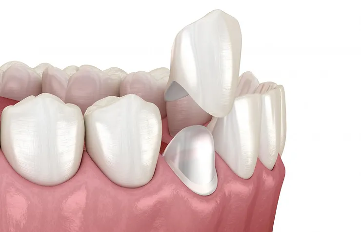 Коронка на зуб — виды, противопоказания к установке, достоинства и недостатки