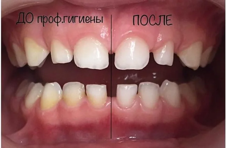 Важный и ранимый возраст для зубов у детей от 3 до 5. О важности гигиены.